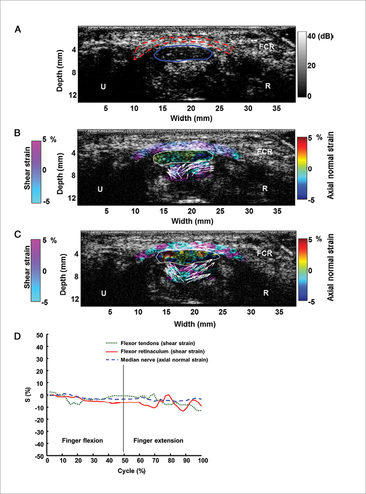 Ultrasound strain imaging of carpal tunnel Ultrasound strain imaging of carpal tunnel
