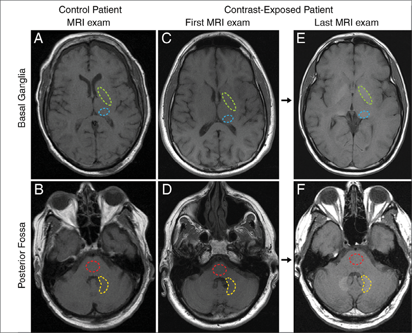 In June 2015 Radiology research, Robert McDonald, M.D., Ph.D., and colleagues set out to determine if repeated intravenous exposures to gadolinium-based contrast agents (GBCAs) are associated with neuronal tissue deposition. In June 2015 Radiology research, Robert McDonald, M.D., Ph.D., and colleagues set out to determine if repeated intravenous exposures to gadolinium-based contrast agents (GBCAs) are associated with neuronal tissue deposition.
