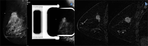 Figure 1: Mammography and MR imaging in a 46-year-old woman with a palpable mass in the right breast. Figure 1: Mammography and MR imaging in a 46-year-old woman with a palpable mass in the right breast.