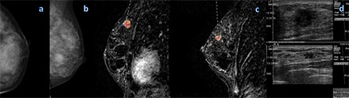 Figure 2: Mammography and MR imaging in a 48-year-old woman with high risk for breast cancer. Figure 2: Mammography and MR imaging in a 48-year-old woman with high risk for breast cancer.