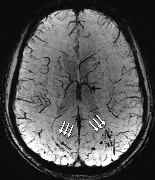 Figure 1. Susceptibility-weighted image shows extensive microhemorrhage (arrows) consistent with diffuse axonal injury Figure 1. Susceptibility-weighted image shows extensive microhemorrhage (arrows) consistent with diffuse axonal injury