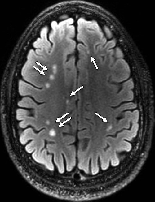 Figure 2. Axial T2 FLAIR image shows multiple white matter T2-weighted hyperintense areas (arrows) in a 28-year-old man with blast-related mild TBI. This patient had a total of 76 lesions on all sections. Figure 2. Axial T2 FLAIR image shows multiple white matter T2-weighted hyperintense areas (arrows) in a 28-year-old man with blast-related mild TBI. This patient had a total of 76 lesions on all sections.