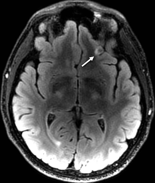 Figure 3. Axial T2 FLAIR image with small focus of encephalomalacia—the softening or loss of brain tissue—and gliosis in the inferior left frontal lobe (arrow) in a 26-year-old man with blast-related mild TBI. Figure 3. Axial T2 FLAIR image with small focus of encephalomalacia—the softening or loss of brain tissue—and gliosis in the inferior left frontal lobe (arrow) in a 26-year-old man with blast-related mild TBI.