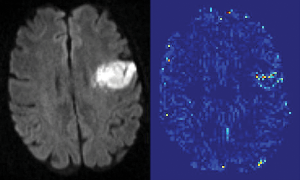 Shown are two different MRI images of the same part of the brain of the same patient. Shown are two different MRI images of the same part of the brain of the same patient.