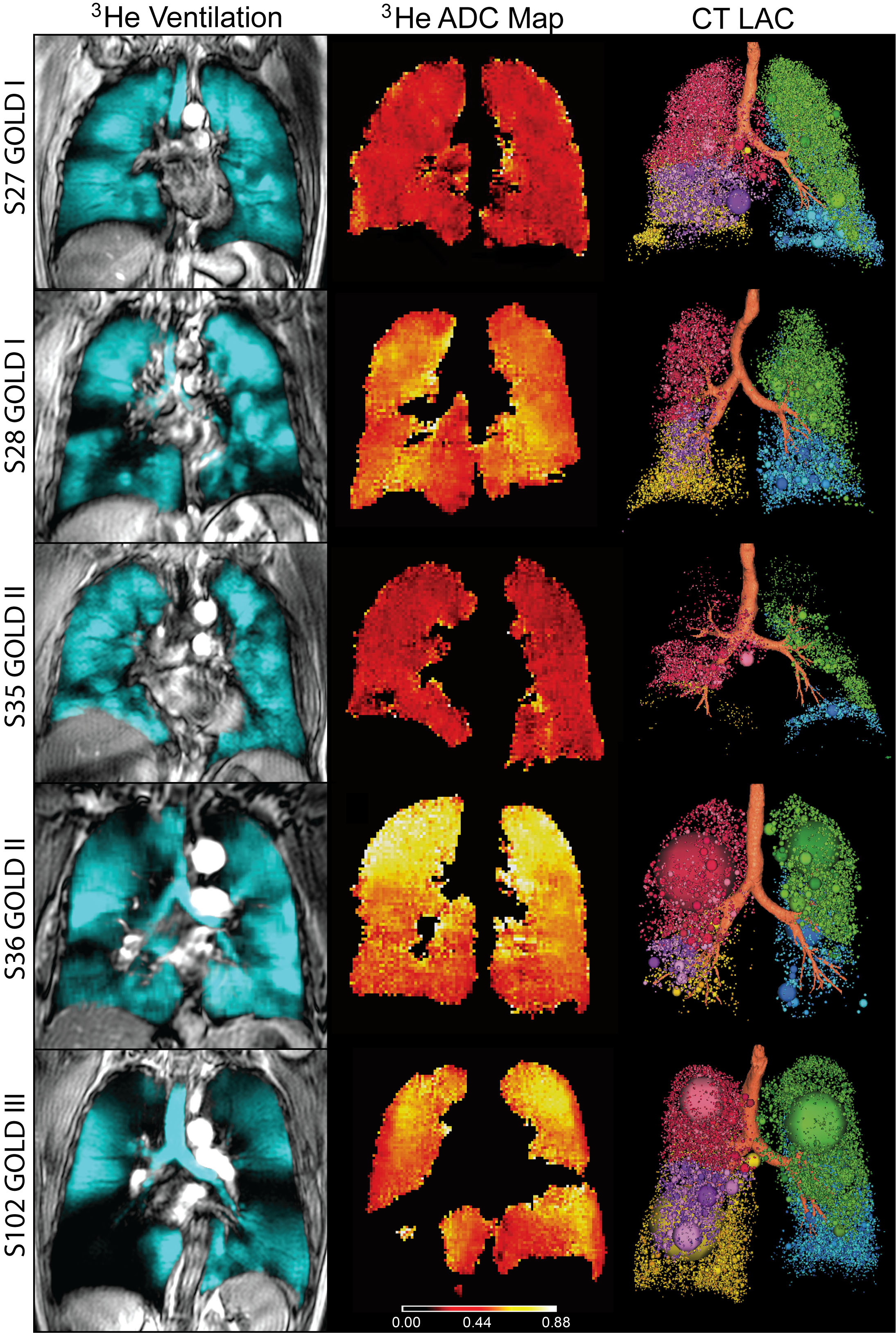 Images in representative patients with mild-to-moderate or severe chronic obstructive pulmonary disease (COPD). Images in representative patients with mild-to-moderate or severe chronic obstructive pulmonary disease (COPD).