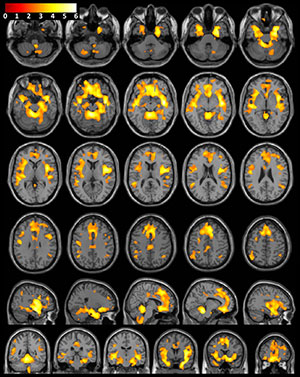 T1-weighted MR imaging examination of the brain with superimposed population-level T-value map T1-weighted MR imaging examination of the brain with superimposed population-level T-value map