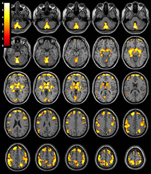 T1-weighted MR imaging exami¬nation of the brain with superimposed population-level T-value map T1-weighted MR imaging exami¬nation of the brain with superimposed population-level T-value map