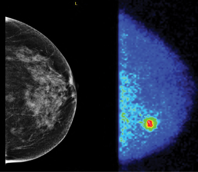 A patient with negative mammogram, molecular breast imaging (MBI) positive. A patient with negative mammogram, molecular breast imaging (MBI) positive.
