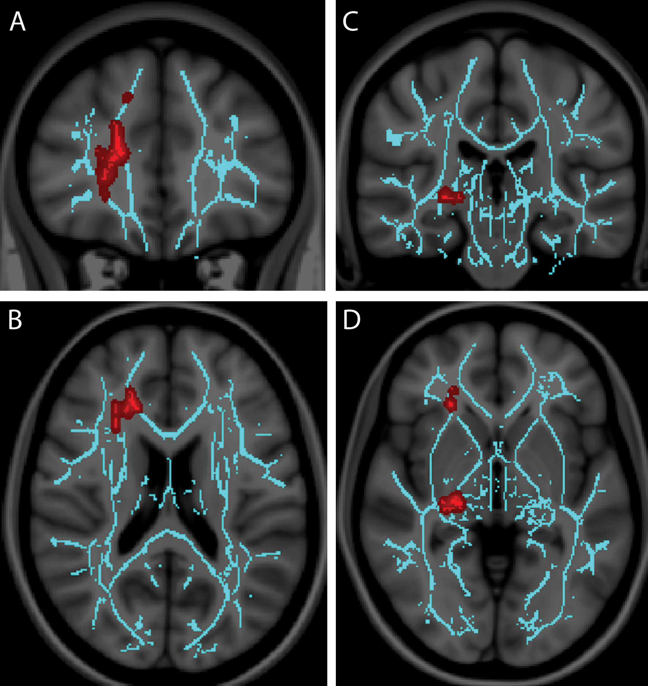 Recent research in Radiology suggests a role for diffusion tensor imaging (DTI) in mild traumatic brain injury (mTBI) diagnosis Recent research in Radiology suggests a role for diffusion tensor imaging (DTI) in mild traumatic brain injury (mTBI) diagnosis