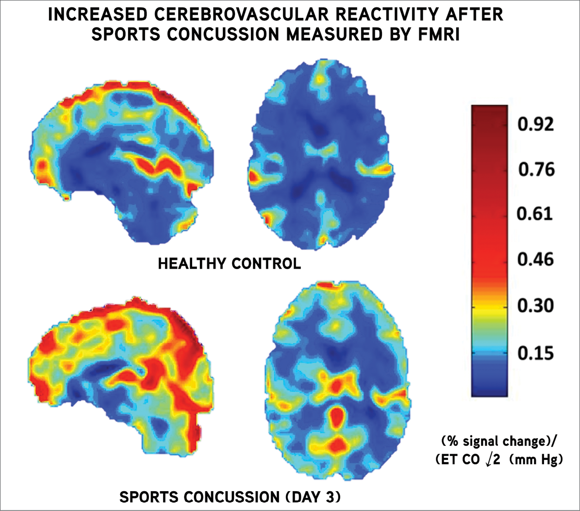 In research presented at RSNA 2014, authors demonstrated that cerebrovascular reactivity (CVR) measured by functional MRI (fMRI) was increased in the first few days after sports concussion compared to healthy, age-matched control subjects. In research presented at RSNA 2014, authors demonstrated that cerebrovascular reactivity (CVR) measured by functional MRI (fMRI) was increased in the first few days after sports concussion compared to healthy, age-matched control subjects.