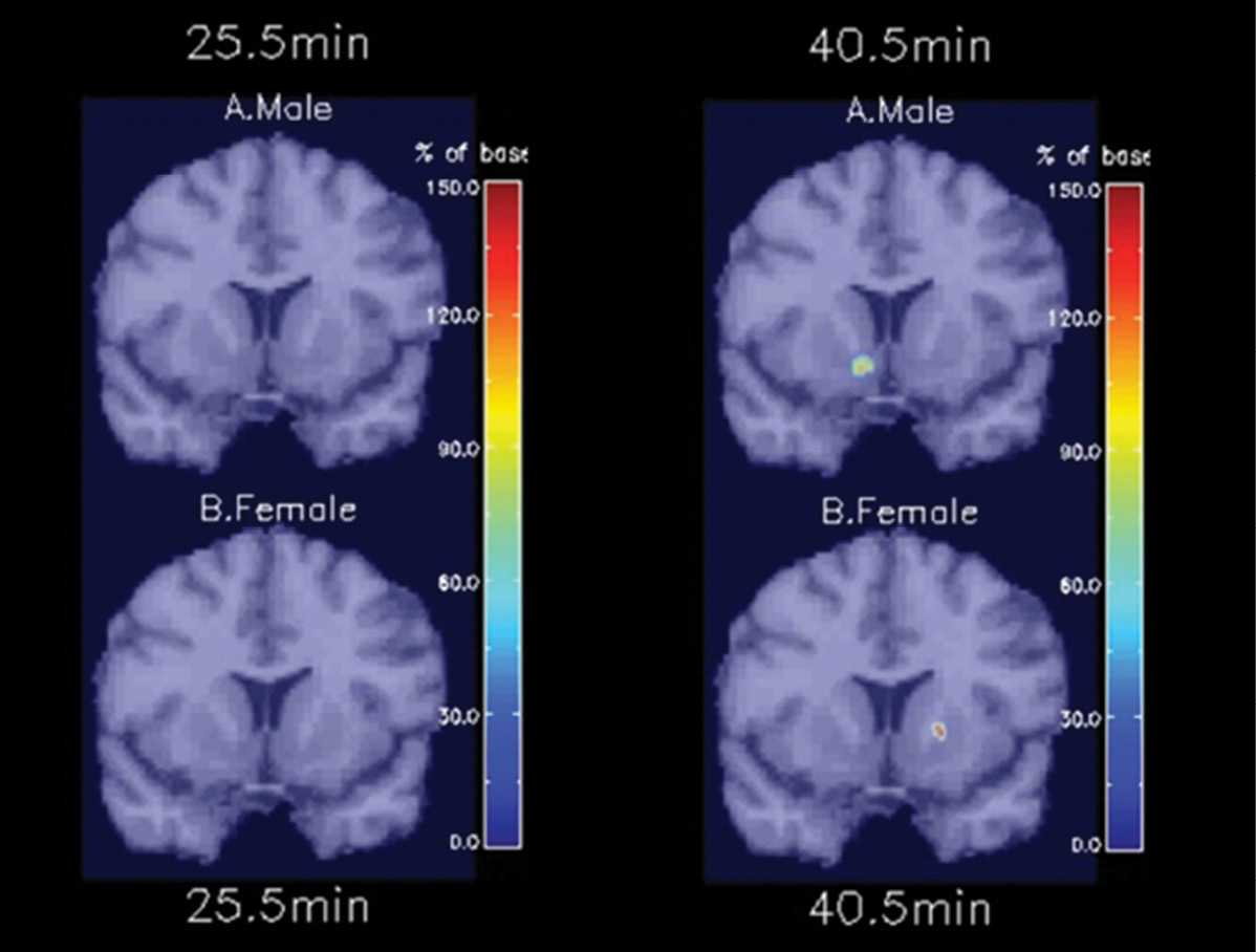 Demonstrating that smoking-induced dopamine activation occurs in a different brain region and much faster in nicotine-dependent men than women Demonstrating that smoking-induced dopamine activation occurs in a different brain region and much faster in nicotine-dependent men than women