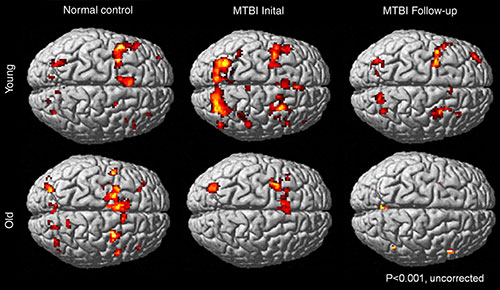 Different working memory activation patterns in healthy control subjects and young and old patients with mild traumatic brain injury. Different working memory activation patterns in healthy control subjects and young and old patients with mild traumatic brain injury.