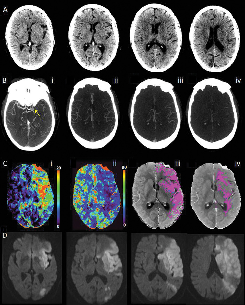 Multimodal CT images obtained 2 hours 18 minutes after symptom onset in an 87-year-old woman with an NIH Stroke Scale of 15 and left hemisphere symptoms. Multimodal CT images obtained 2 hours 18 minutes after symptom onset in an 87-year-old woman with an NIH Stroke Scale of 15 and left hemisphere symptoms.