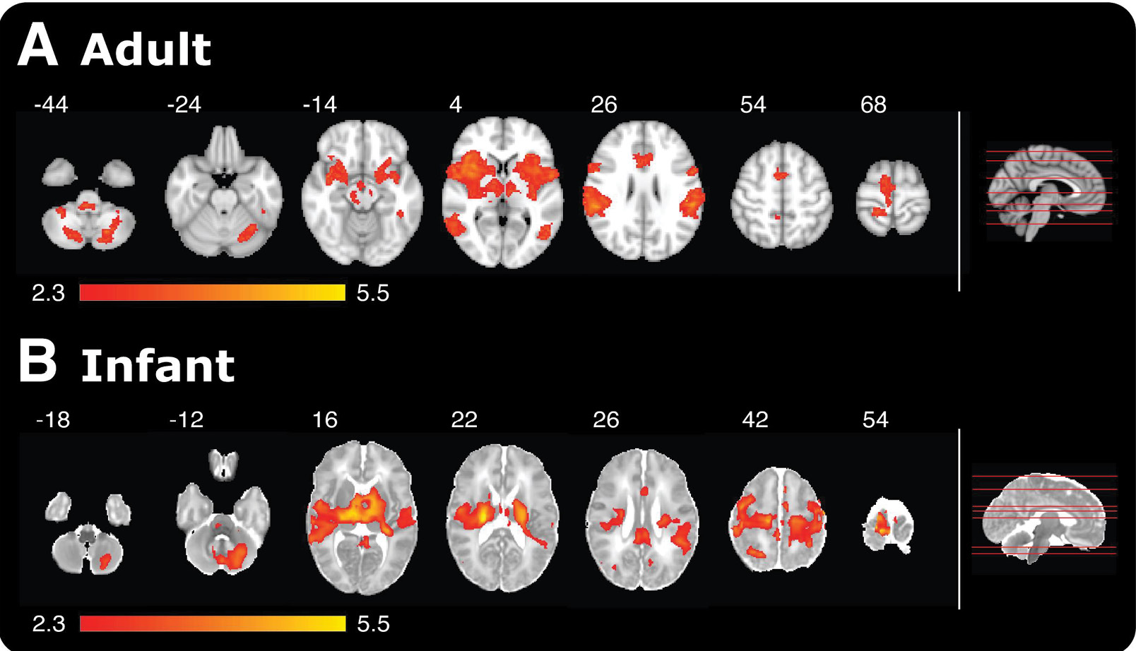 An MRI scan comparing brain activity in adults and infants when poked with the special retracting rod simulating a sensation of pain. An MRI scan comparing brain activity in adults and infants when poked with the special retracting rod simulating a sensation of pain.