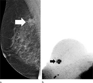 Figure 1. Images in 65-year-old breast cancer screening participant with a suspicious lesion (arrow) at screening mammography. Figure 1. Images in 65-year-old breast cancer screening participant with a suspicious lesion (arrow) at screening mammography.