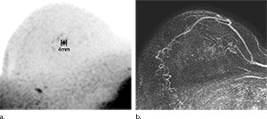 Figure 2. Images show example of a screening-detected lesion in a 67-year-old breast cancer screening patient. Figure 2. Images show example of a screening-detected lesion in a 67-year-old breast cancer screening patient.