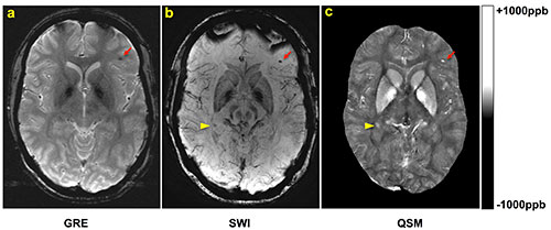 A, gradient-recalled-echo (GRE), B, susceptibility-weighted imaging (SWI), and, C, quantitative susceptibility mapping (QSM) images in a patient with traumatic brain injury. A, gradient-recalled-echo (GRE), B, susceptibility-weighted imaging (SWI), and, C, quantitative susceptibility mapping (QSM) images in a patient with traumatic brain injury.