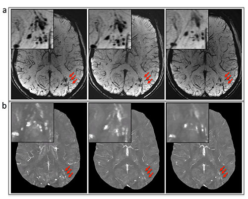 A, susceptibility-weighted imaging and, B, quantitative susceptibility mappingimages show the evolution of microhemorrhages (arrows) in a patient who underwent follow-up imaging. A, susceptibility-weighted imaging and, B, quantitative susceptibility mappingimages show the evolution of microhemorrhages (arrows) in a patient who underwent follow-up imaging.