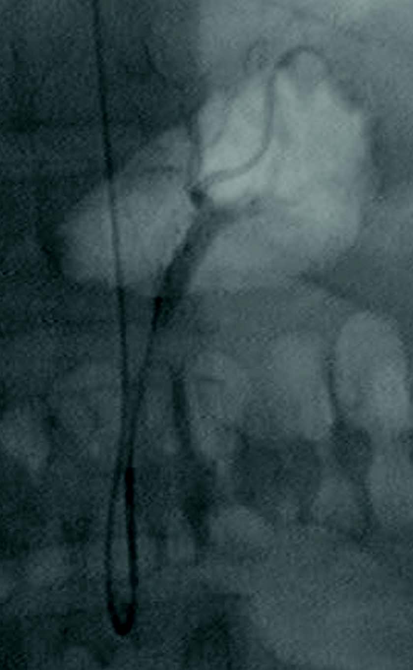 Embolization of the left gastric artery via radial artery approach in a morbidly obese patient. Embolization of the left gastric artery via radial artery approach in a morbidly obese patient.