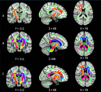 Tract-based analysis for whole WM tracts. A, Significant differences in WM detected from analysis of tract-based spatial statistics. Tract-based analysis for whole WM tracts. A, Significant differences in WM detected from analysis of tract-based spatial statistics.