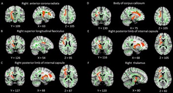 Significant WM clusters obtained from tract-based spatial statistics between primary insomnia and HC groups. Significant WM clusters obtained from tract-based spatial statistics between primary insomnia and HC groups.