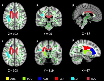 Distribution of the six whole WM tracts in the brain. ALIC = anterior limb of the internal capsule, ACR= anterior corona radiata, BCC = body of the corpus callosum, PLIC = posterior limb of the internal capsule,R = right side of the brain, SCR = superior corona radiata, SLF = superior longitudinal fasciculus. Distribution of the six whole WM tracts in the brain. ALIC = anterior limb of the internal capsule, ACR= anterior corona radiata, BCC = body of the corpus callosum, PLIC = posterior limb of the internal capsule,R = right side of the brain, SCR = superior corona radiata, SLF = superior longitudinal fasciculus.