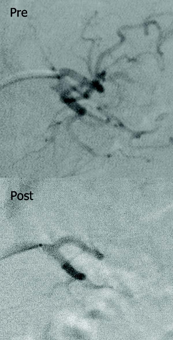 Pre-and post-bariatric embolization images of the main trunk of the left gastric artery in a morbidly obese diabetic patient. Pre-and post-bariatric embolization images of the main trunk of the left gastric artery in a morbidly obese diabetic patient.