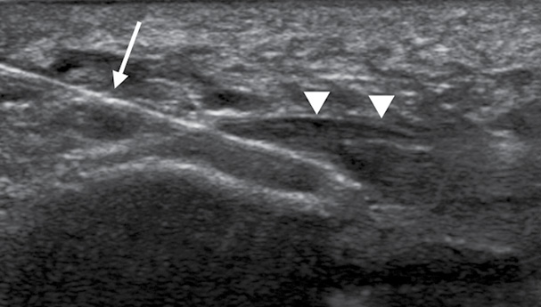 The effectiveness of platelet-rich plasma injections in treating plantar fasciitis The effectiveness of platelet-rich plasma injections in treating plantar fasciitis