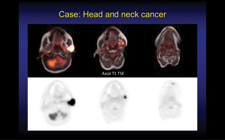 Selected F-18 fluorodeoxyglucose (FDG)-PET/MRI images from a clinical study in a patient with a recurrent adenocarcinoma Selected F-18 fluorodeoxyglucose (FDG)-PET/MRI images from a clinical study in a patient with a recurrent adenocarcinoma