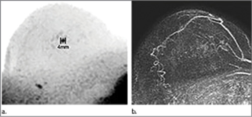 Images of a screening-detected lesion in a 67-year-old breast cancer screening patient. Images of a screening-detected lesion in a 67-year-old breast cancer screening patient.