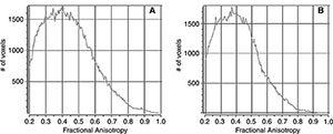 Sample histograms for, A, a control subject and, B, a patient with mild traumatic brain injury. Sample histograms for, A, a control subject and, B, a patient with mild traumatic brain injury.