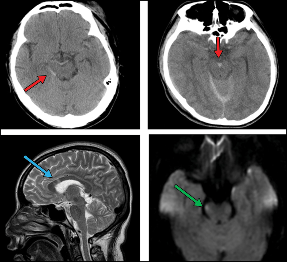 An image from Dr. Mbemba's research showing the initial CT performed 50 minutes after onset showed the presence of midline (perimesencephalic) subarachnoid hemorrhage An image from Dr. Mbemba's research showing the initial CT performed 50 minutes after onset showed the presence of midline (perimesencephalic) subarachnoid hemorrhage