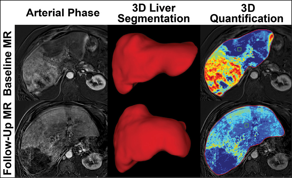 Liver images captured before (top row) and after (bottom) treatment. Liver images captured before (top row) and after (bottom) treatment.