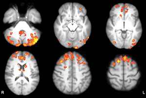 Axial statistical maps show areas of reduced thalamic functional connectivity (FC) in patients with MS compared with that in healthy subjects. Axial statistical maps show areas of reduced thalamic functional connectivity (FC) in patients with MS compared with that in healthy subjects.