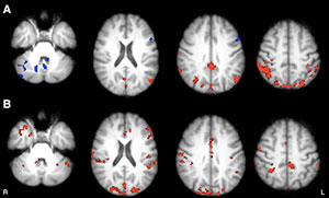 Axial functional connectivity (FC) maps show changes in thalamic FC after 8 weeks in both groups of patients with MS. Areas of increased FC are represented in red, areas of reduced FC in blue. Axial functional connectivity (FC) maps show changes in thalamic FC after 8 weeks in both groups of patients with MS. Areas of increased FC are represented in red, areas of reduced FC in blue.