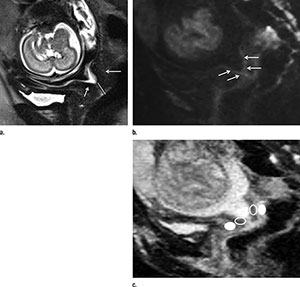 Axial statistical maps show areas of reduced thalamic functional connectivity (FC) in patients with MS compared with that in healthy subjects. Axial statistical maps show areas of reduced thalamic functional connectivity (FC) in patients with MS compared with that in healthy subjects.