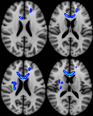 Blue indicates regions of the brain in which lower fractional anisotropy (a measure of microstructural integrity) correlated with more severe neurobehavioral symptoms. Blue indicates regions of the brain in which lower fractional anisotropy (a measure of microstructural integrity) correlated with more severe neurobehavioral symptoms.