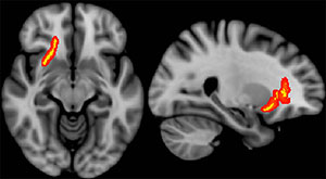 Red/yellow indicates regions of the brain in which fractional anisotropy correlated with time since most severe TBI event. Red/yellow indicates regions of the brain in which fractional anisotropy correlated with time since most severe TBI event.
