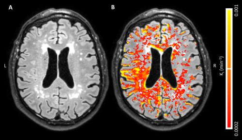 A, Axial fluid-attenuated inversion recovery image in a 68-year-old man with, B, corresponding blood-brain barrier leakage rate (Ki) maps superimposed A, Axial fluid-attenuated inversion recovery image in a 68-year-old man with, B, corresponding blood-brain barrier leakage rate (Ki) maps superimposed