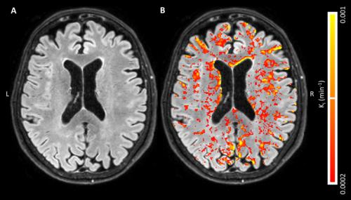 A, Axial fluid-attenuated inversion recovery image in an 80-year-old woman healthy control subject with, B, corresponding blood-brain barrier leakage rate (Ki) maps superimposed A, Axial fluid-attenuated inversion recovery image in an 80-year-old woman healthy control subject with, B, corresponding blood-brain barrier leakage rate (Ki) maps superimposed