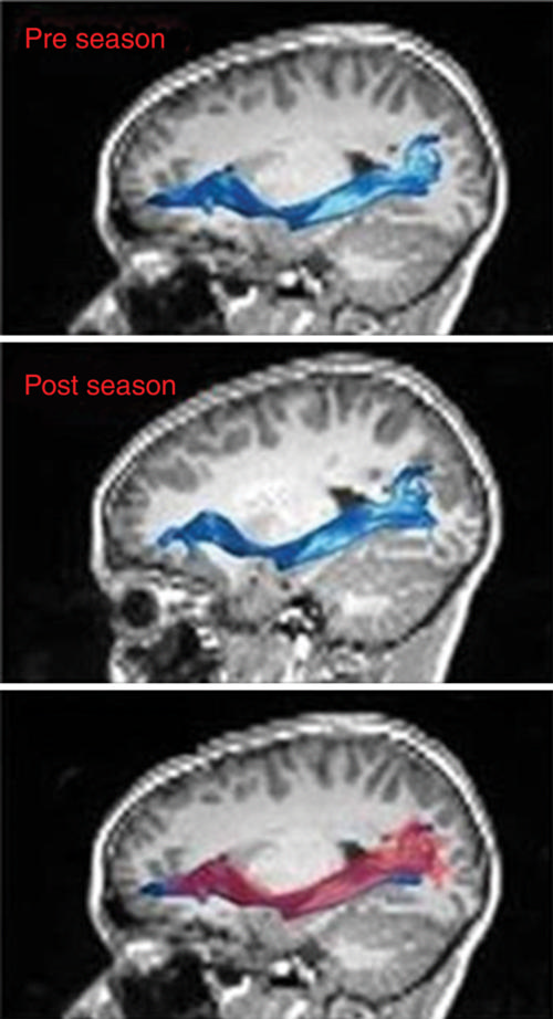 MR images of left inferior fronto-occipital fasciculus MR images of left inferior fronto-occipital fasciculus