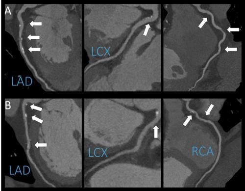 A representative example of coronary CT angiography A representative example of coronary CT angiography