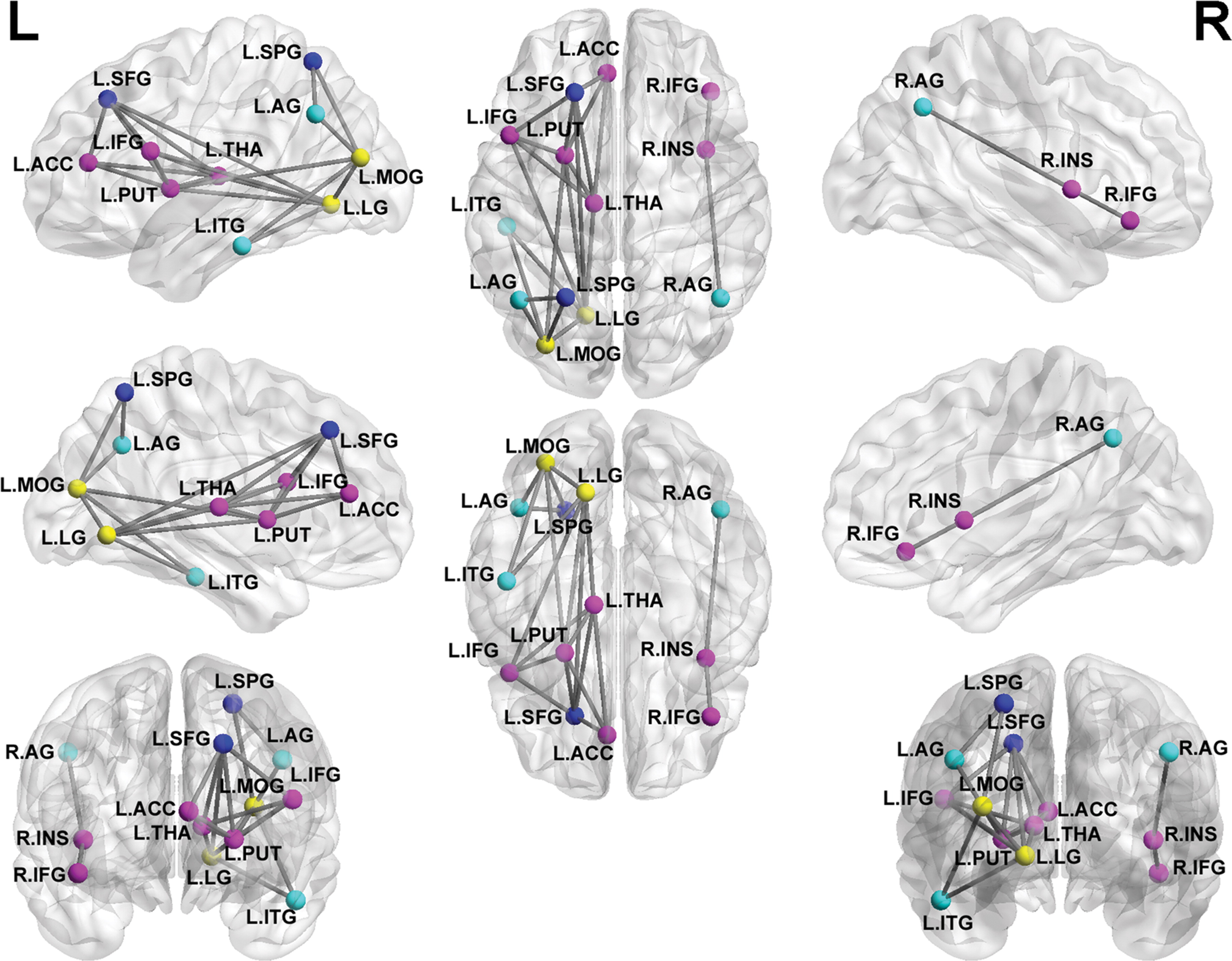 Pediatric PTSD-related subnetwork. Every node denotes a brain region, and every line denotes a connection. Different-color nodes represent different brain regions: purple, salience network; dark blue, central executive network; blue, default mode network; yellow, visual regions. ACC = anterior cingulate cortex, AG = angular gyrus, IFG = inferior frontal gyrus, INS = insula, ITG = inferior temporal gyrus, L or L. = left, LG = lingual gyrus, MOG = middle occipital gyrus, PUT = putamen, R or R. = right, SFG = superior frontal gyrus, SPG = superior parietal gyrus, THA = thalamus. Pediatric PTSD-related subnetwork. Every node denotes a brain region, and every line denotes a connection. Different-color nodes represent different brain regions: purple, salience network; dark blue, central executive network; blue, default mode network; yellow, visual regions. ACC = anterior cingulate cortex, AG = angular gyrus, IFG = inferior frontal gyrus, INS = insula, ITG = inferior temporal gyrus, L or L. = left, LG = lingual gyrus, MOG = middle occipital gyrus, PUT = putamen, R or R. = right, SFG = superior frontal gyrus, SPG = superior parietal gyrus, THA = thalamus.