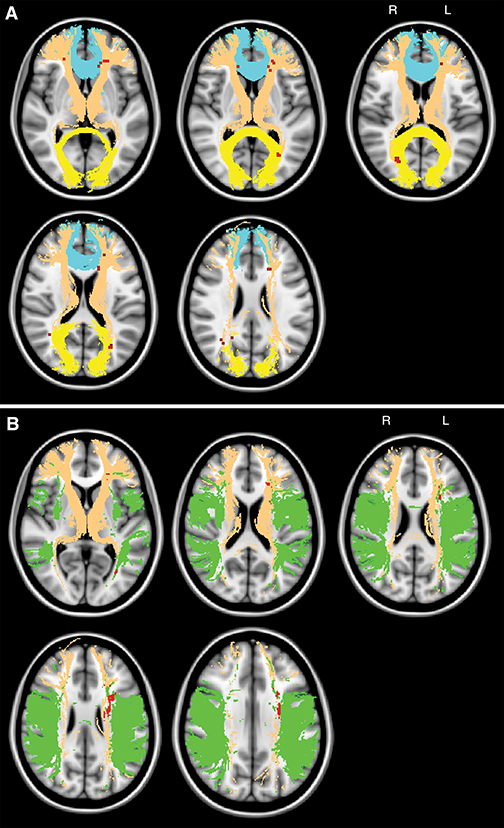 Maps show the topography of chronic ischemic lesions associated with global cognitive impairment. Maps show the topography of chronic ischemic lesions associated with global cognitive impairment.