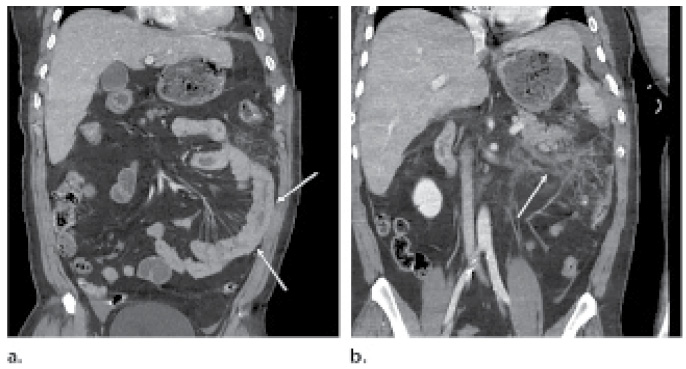 Focal bowel wall thickening Focal bowel wall thickening