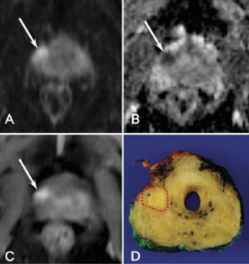 Images in a 74-year-old man with clinically significant prostate cancer Images in a 74-year-old man with clinically significant prostate cancer