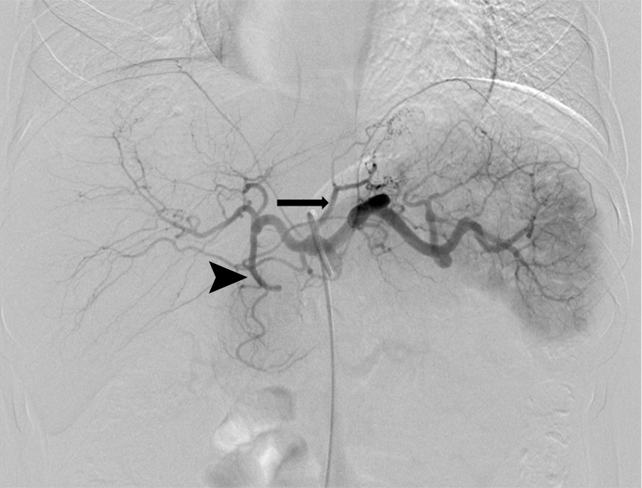 Example of bariatric embolization Example of bariatric embolization
