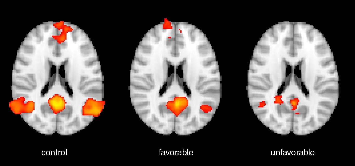 Functional MRI activation Functional MRI activation