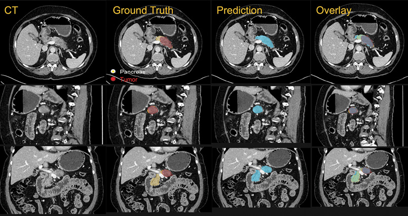 An example of the computer's ability to recognize not only the pancreas but the pancreatic cancer
