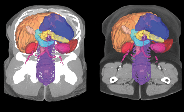 Color-coded mapping of the segmentation of the abdominal organs